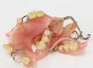 クラスプ デンチャー